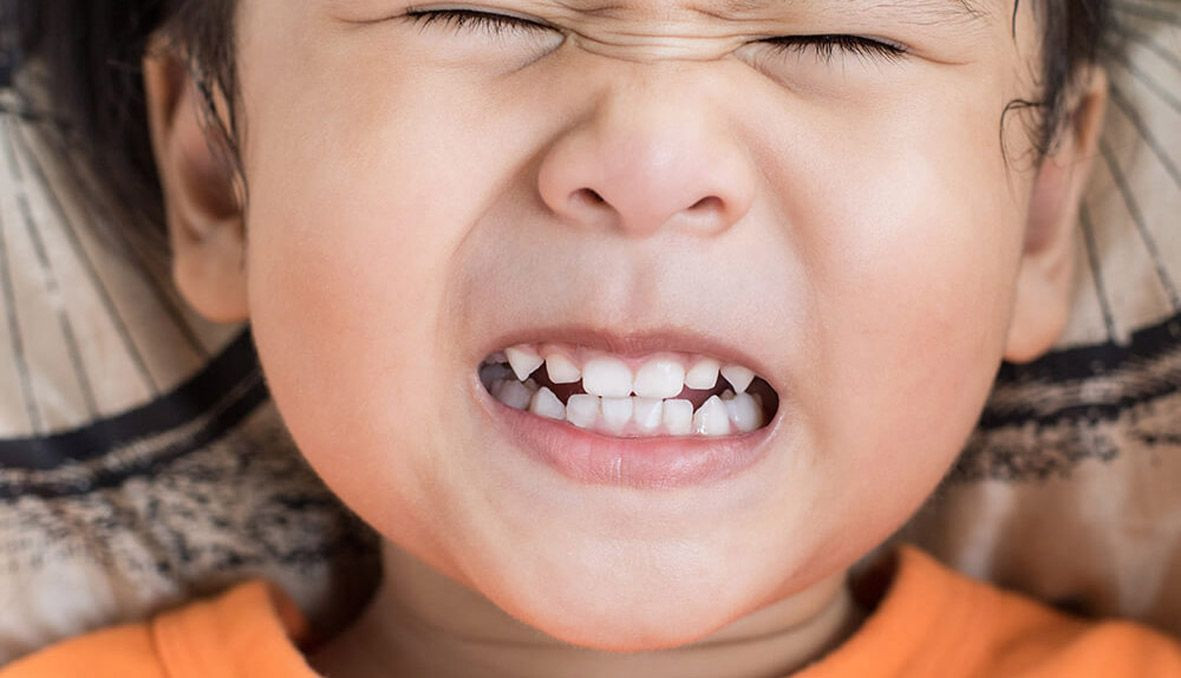 Bruxism Pada Anak